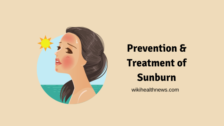 Sunburn Symptoms, Treatment & Prevention - Wiki Health News