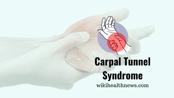 Carpal Tunnel Syndrome Causes Pain In Hand - wiki Health News